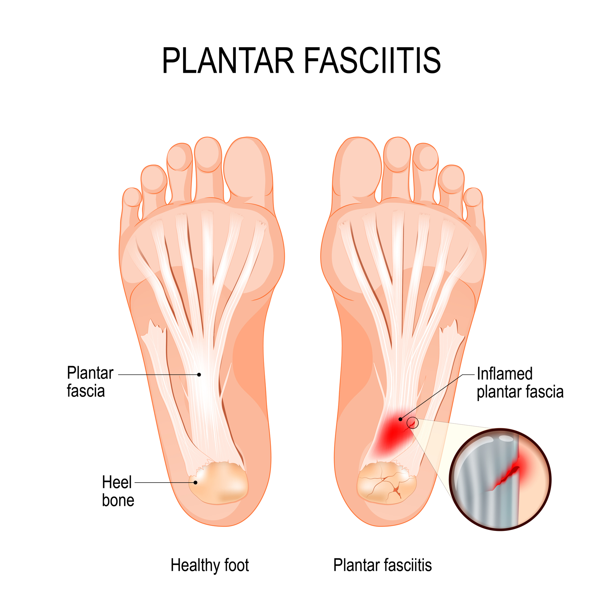 Plantar fasciitis: Symptoms, causes, and treatments - Harvard Health