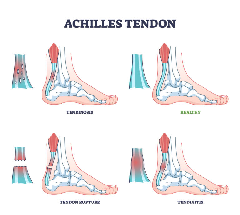 Achilles Tendonitis – Family Podiatry of MD