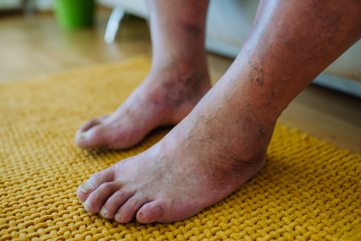 diabetic feet with varicose veins